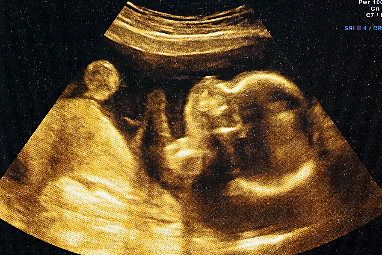 Unborn baby ultrasound at 24 weeks