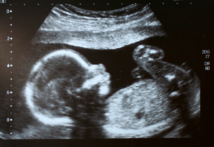 ultrasound of unborn baby